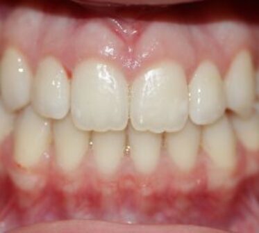After - Cosmetic & Family Dentistry