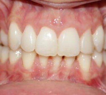 After - Cosmetic & Family Dentistry