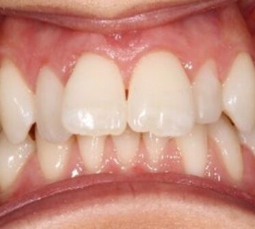 Before - Cosmetic & Family Dentistry